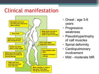 Clinical manifestation
• Onset : age 3-6
years
• Progressive
weakness
• Pseudohypertrophy
of calf muscles
• Spinal deformity
• Cardiopulmonary
involvement
• Mild - moderate MR
 