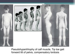 Pseudohypertrhophy of calf muscle, Tip toe gait
forward tilt of pelvis, compensatory lordosis
 
