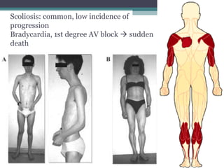 Scoliosis: common, low incidence of
progression
Bradycardia, 1st degree AV block  sudden
death
 