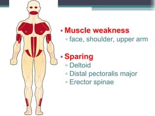 • Muscle weakness
▫ face, shoulder, upper arm
• Sparing
▫ Deltoid
▫ Distal pectoralis major
▫ Erector spinae
 