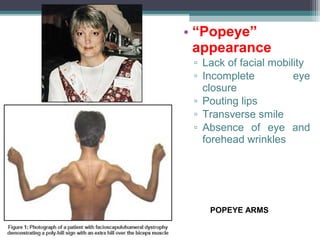 • “Popeye”
appearance
▫ Lack of facial mobility
▫ Incomplete eye
closure
▫ Pouting lips
▫ Transverse smile
▫ Absence of eye and
forehead wrinkles
POPEYE ARMS
 