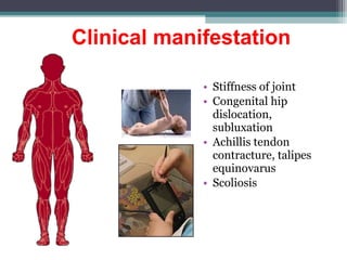 Clinical manifestation
• Stiffness of joint
• Congenital hip
dislocation,
subluxation
• Achillis tendon
contracture, talipes
equinovarus
• Scoliosis
 