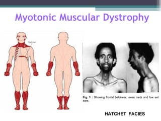 Myotonic Muscular Dystrophy
HATCHET FACIES
 