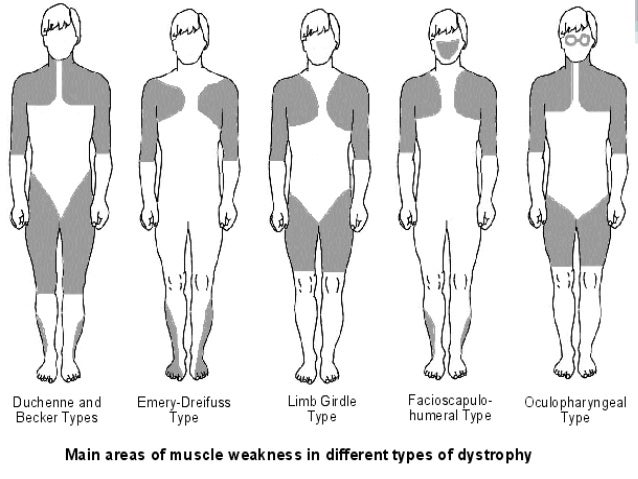 Duchenne Muscular Dystrophy Natural History Duchenne Muscular Dystrophy Natural History