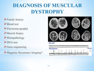 DIAGNOSIS OF MUSCULAR
DYSTROPHY
Family history
Blood test
Electromyography
Muscle biopsy
Histopathology
DNA test
Gene sequencing
Magnetic Resonance Imaging[3]
11
 