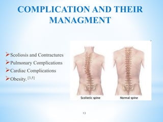 COMPLICATION AND THEIR
MANAGMENT
Scoliosis and Contractures
Pulmonary Complications
Cardiac Complications
Obesity. [3,5]
13
 