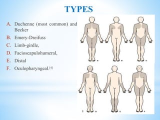 TYPES
A. Duchenne (most common) and
Becker
B. Emery-Dreifuss
C. Limb-girdle,
D. Facioscapulohumeral,
E. Distal
F. Oculopharyngeal.[4]
8
 