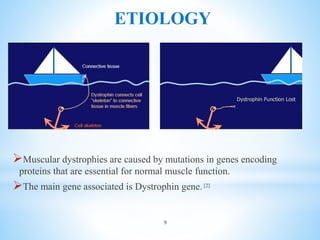 ETIOLOGY
Muscular dystrophies are caused by mutations in genes encoding
proteins that are essential for normal muscle function.
The main gene associated is Dystrophin gene.[2]
9
 