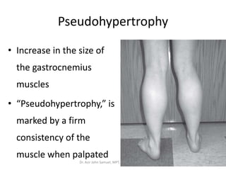 Pseudohypertrophy
• Increase in the size of
the gastrocnemius
muscles
• “Pseudohypertrophy,” is
marked by a firm
consistency of the
muscle when palpated
Dr. Asir John Samuel, MPT, PhD, Assoc. Prof. 21
 