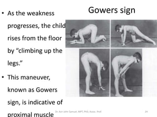 Gowers sign• As the weakness
progresses, the child
rises from the floor
by “climbing up the
legs.”
• This maneuver,
known as Gowers
sign, is indicative of
proximal muscle
Dr. Asir John Samuel, MPT, PhD, Assoc. Prof. 24
 