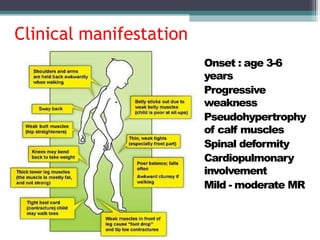 Clinical manifestation
• Onset : age 3-6
years
• Progressive
weakness
• Pseudohypertrophy
of calf muscles
• Spinal deformity
• Cardiopulmonary
involvement
• Mild - moderate MR
 