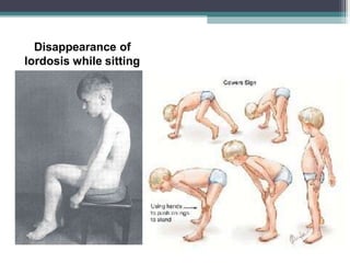 Disappearance of
lordosis while sitting
 