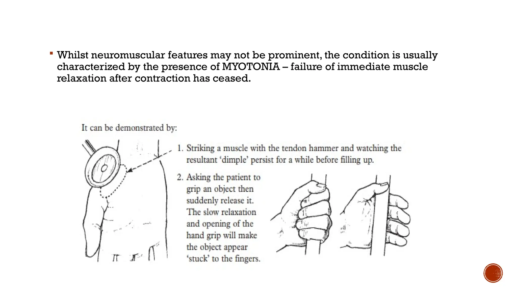 Whilst neuromuscular features may not be prominent, the condition is usually
characterized by the presence of MYOTONIA – failure of immediate muscle
relaxation after contraction has ceased.
 