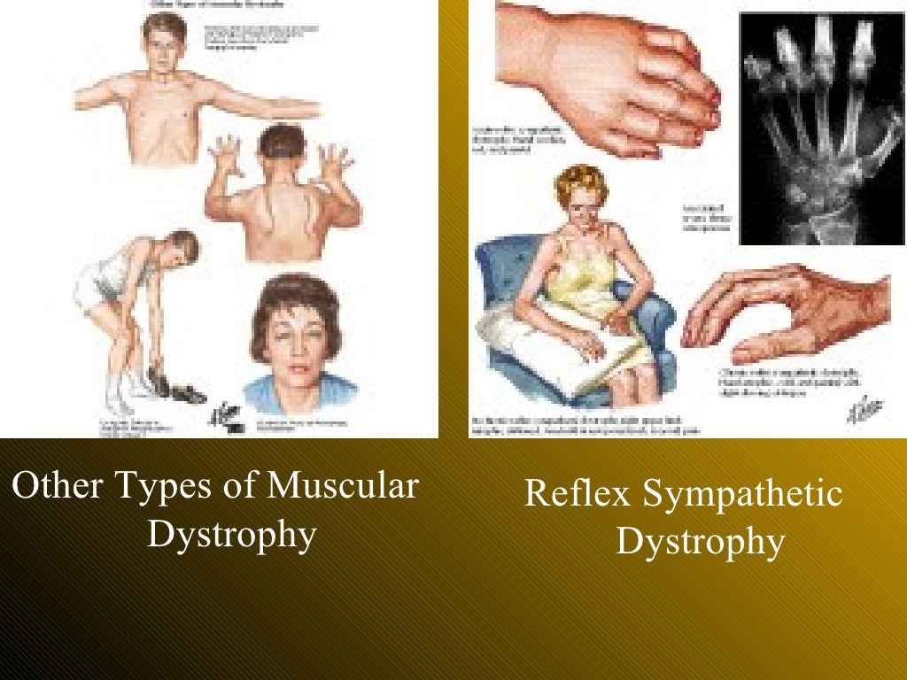 muscle dystrophy research paper