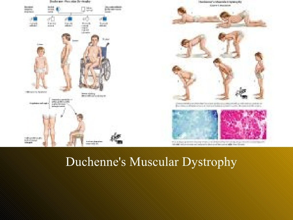 introduction to muscular dystrophy research paper