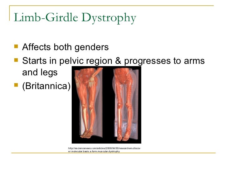 What Is Limb Girdle Muscular Dystrophy – YAFLM