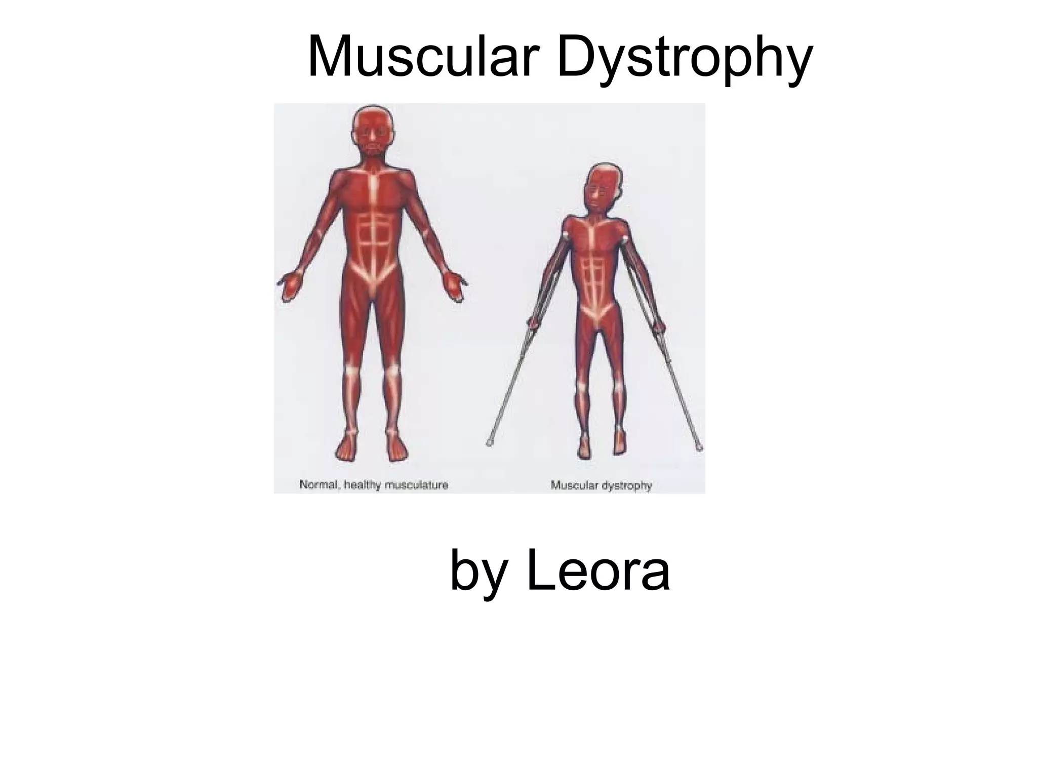 Muscular dystrophy ld | ODP
