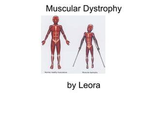 Muscular Dystrophy

by Leora

 