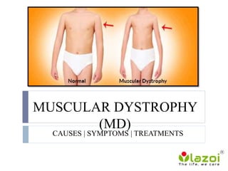 MUSCULAR DYSTROPHY
(MD)
CAUSES | SYMPTOMS | TREATMENTS
 