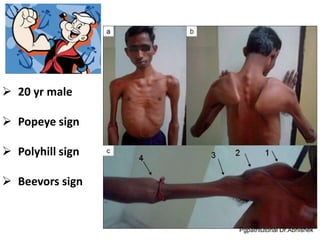 Muscular dystrophy (wecompress.com)_watermark.pdf