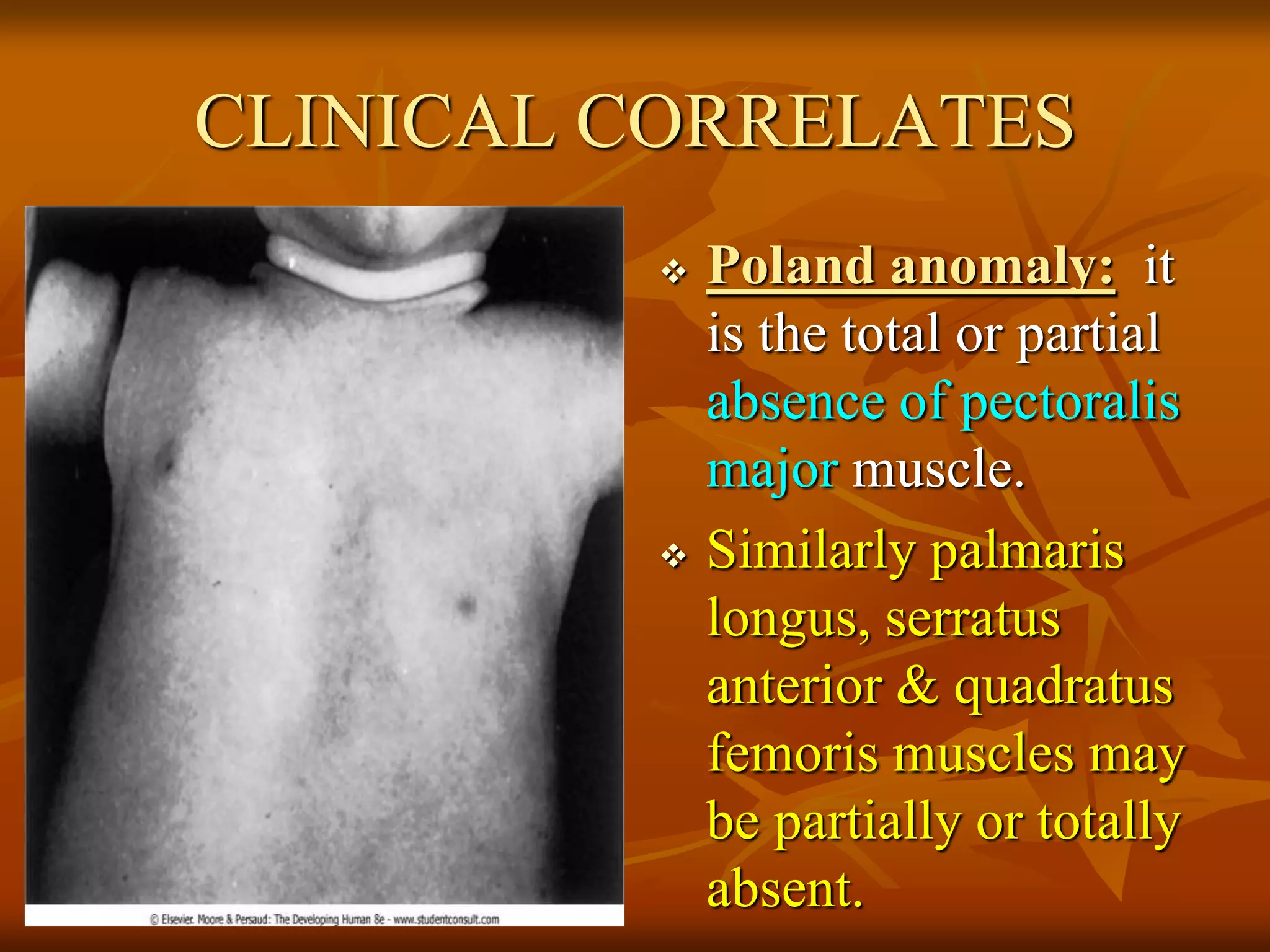 CLINICAL CORRELATES
 Poland anomaly: it
is the total or partial
absence of pectoralis
major muscle.
 Similarly palmaris
longus, serratus
anterior & quadratus
femoris muscles may
be partially or totally
absent.
 