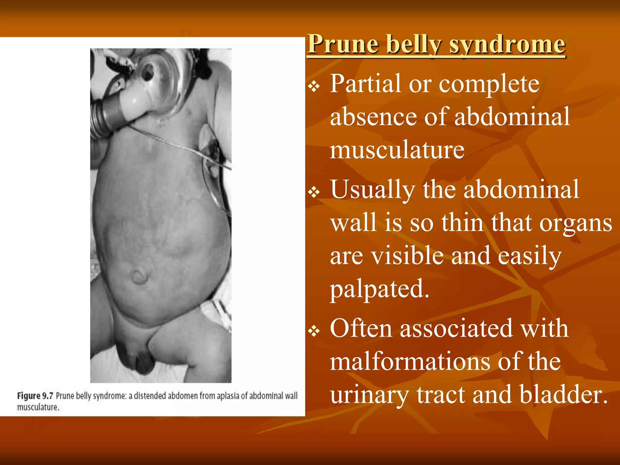 Prune belly syndrome
 Partial or complete
absence of abdominal
musculature
 Usually the abdominal
wall is so thin that organs
are visible and easily
palpated.
 Often associated with
malformations of the
urinary tract and bladder.
 