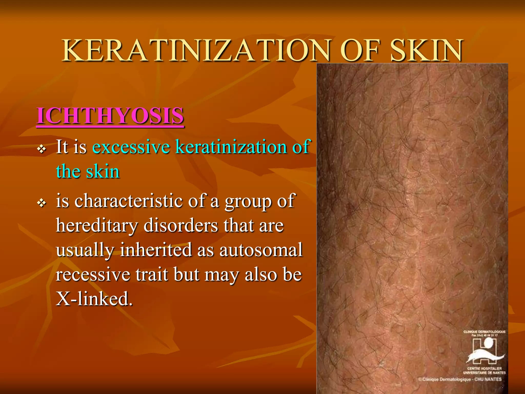KERATINIZATION OF SKIN
ICHTHYOSIS
 It is excessive keratinization of
the skin
 is characteristic of a group of
hereditary disorders that are
usually inherited as autosomal
recessive trait but may also be
X-linked.
 