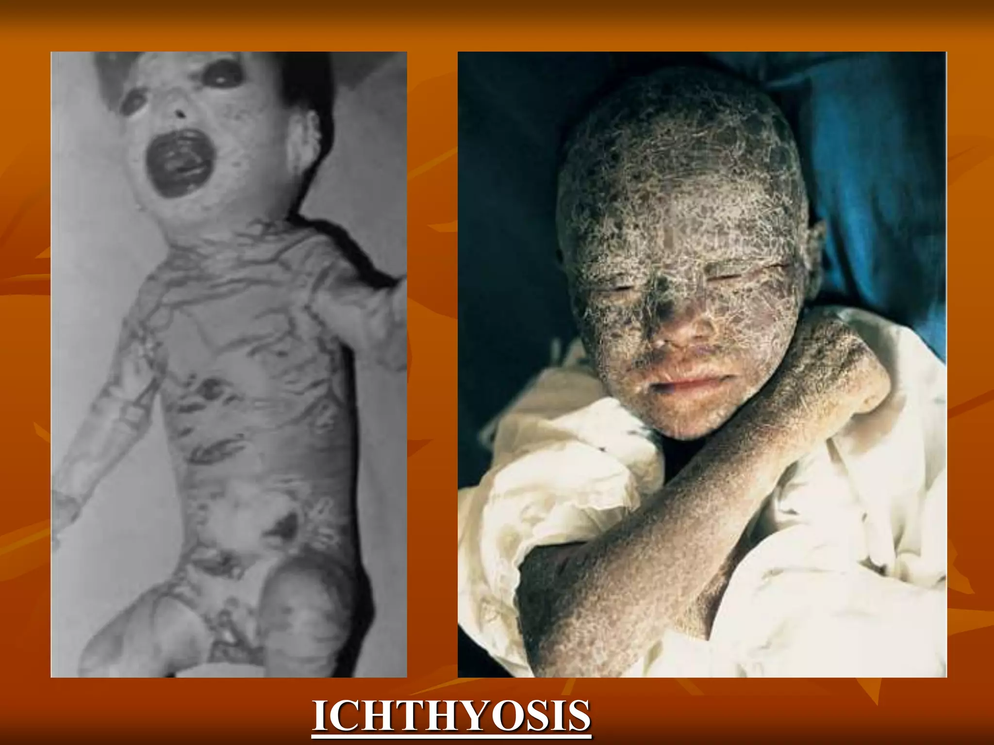 ICHTHYOSIS
 