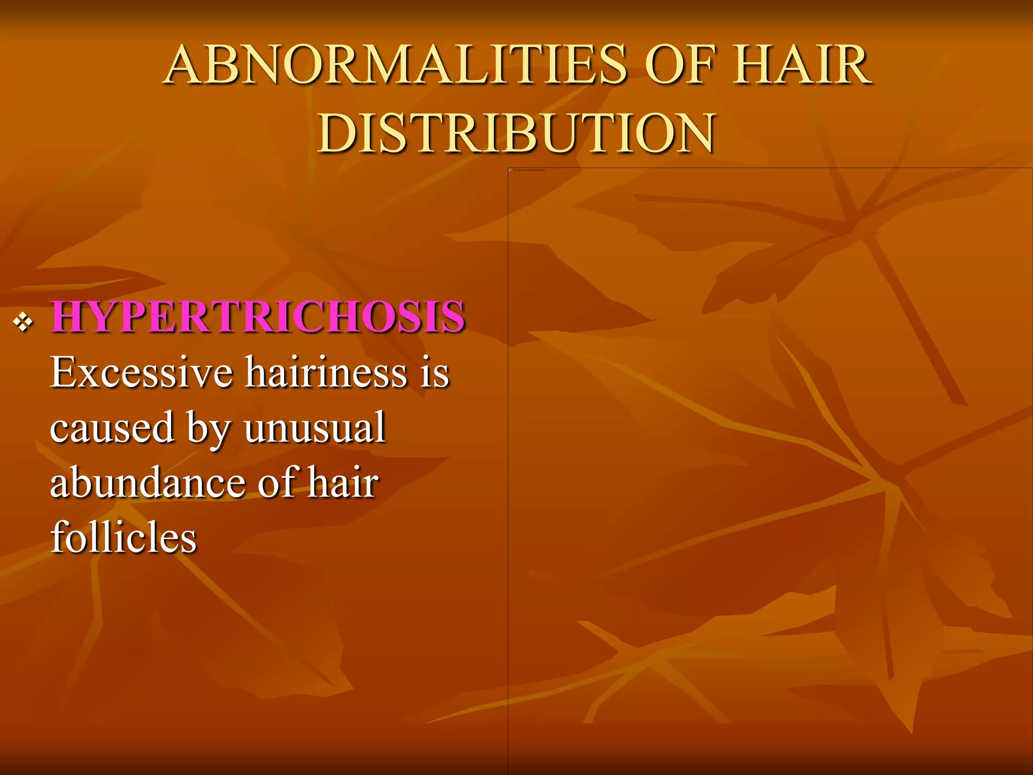 ABNORMALITIES OF HAIR
DISTRIBUTION
 HYPERTRICHOSIS
Excessive hairiness is
caused by unusual
abundance of hair
follicles
 