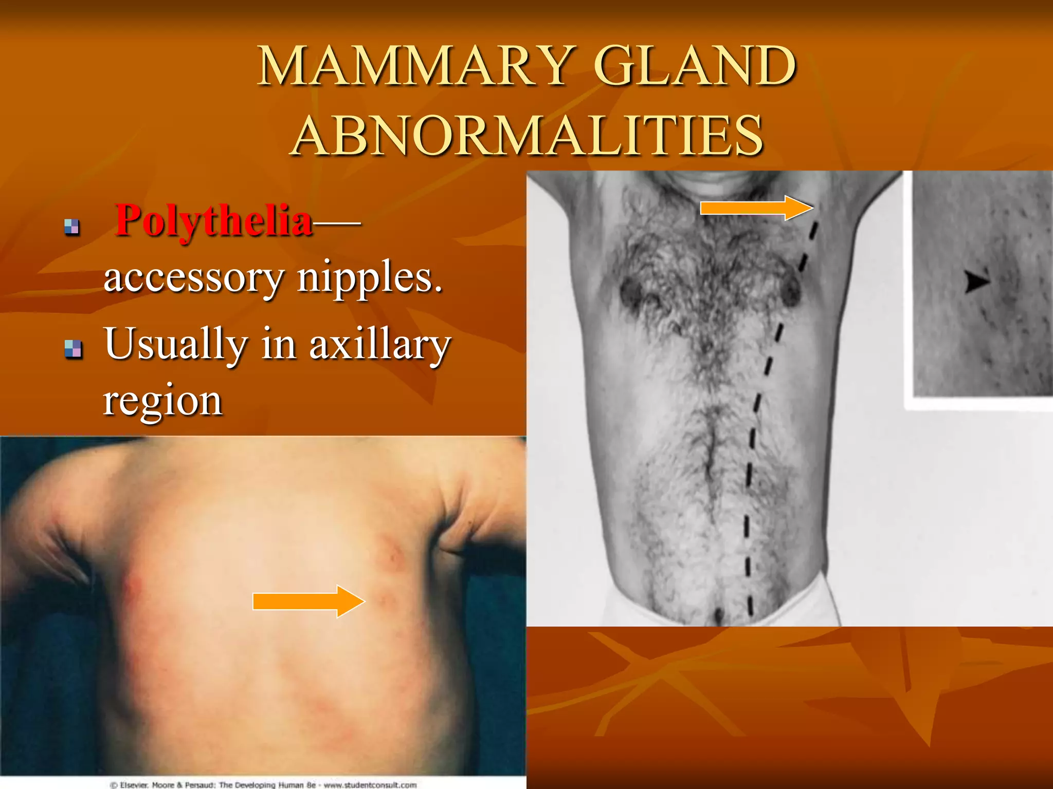 MAMMARY GLAND
ABNORMALITIES
Polythelia—
accessory nipples.
Usually in axillary
region
 