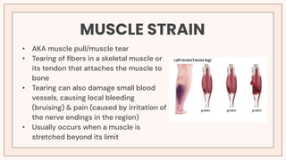 Strained Muscles Antomy Example MUSCULAR SYSTEM human anatomy with patho | PDF