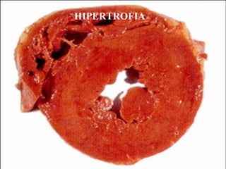 HIPERTROFIA
 