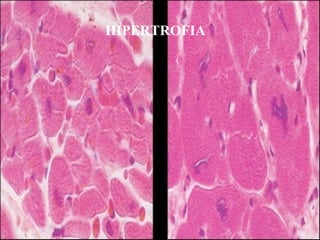 HIPERTROFIA
 
