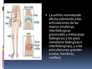  La artritis reumatoide
afecta sobretodo a las
articulaciones de las
manos (muñecas,
interfalángicas
proximales y metacarpo
falángicas) y los pies(
metatarso falángicas e
interfalángicas), y a las
articulaciones grandes
(codos, hombros,
rodillas).
 