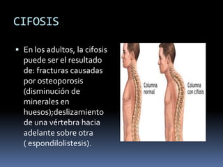 CIFOSIS
 En los adultos, la cifosis
puede ser el resultado
de: fracturas causadas
por osteoporosis
(disminución de
minerales en
huesos);deslizamiento
de una vértebra hacia
adelante sobre otra
( espondilolistesis).
 
