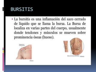 BURSITIS
 
