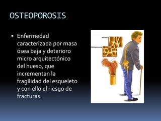 OSTEOPOROSIS
 Enfermedad
caracterizada por masa
ósea baja y deterioro
micro arquitectónico
del hueso, que
incrementan la
fragilidad del esqueleto
y con ello el riesgo de
fracturas.
 