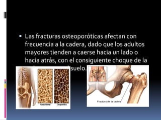  Las fracturas osteoporóticas afectan con
frecuencia a la cadera, dado que los adultos
mayores tienden a caerse hacia un lado o
hacia atrás, con el consiguiente choque de la
cadera contra el suelo.
 