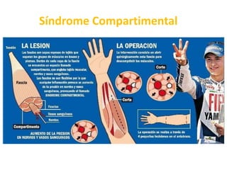  Recibe eferentes de los 5 dedos, de preferencia del anular y meñique. Además recibe el drenaje de músculos y articulaciones de la región hipotenar y anteromedial del antebrazo Cadena Interósea Anterior (2%) Se extiende desde el extremo distal de los vasos interóseos anteriores hasta su intersección con los vasos cubitales.