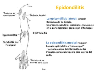  Compuesta por un solo ganglio linfático