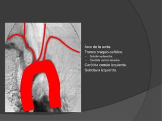  Arco de la aorta.
 Tronco braquio-cefálico.
 Subclavia derecha.
 Carótida común derecha.
 Carótida común izquierda.
 Subclavia izquierda.
 