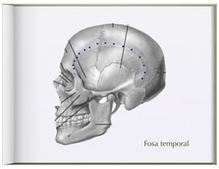 Fosa temporal
 