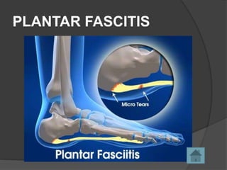 PLANTAR FASCITIS

 