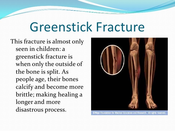 Musculoskeletal System Fractures