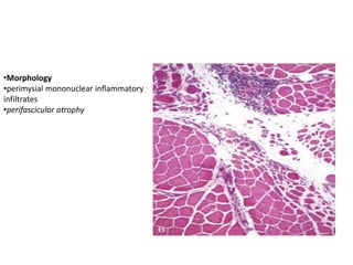 •Morphology
•perimysial mononuclear inflammatory
infiltrates
•perifascicular atrophy
 