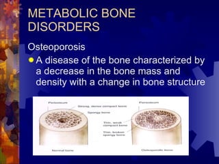 METABOLIC BONE DISORDERS Osteoporosis A disease of the bone characterized by a decrease in the bone mass and density with a change in bone structure 