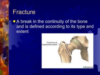 Fracture A break in the continuity of the bone and is defined according to its type and extent 