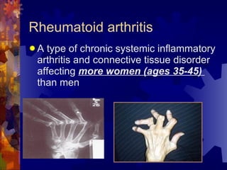 Rheumatoid arthritis <ul><li>A type of chronic systemic inflammatory arthritis and connective tissue disorder affecting  m...
