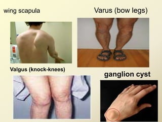 wing scapula Varus (bow legs)
Valgus (knock-knees)
ganglion cyst
 