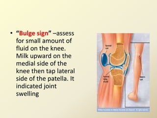 • “Bulge sign” –assess
for small amount of
fluid on the knee.
Milk upward on the
medial side of the
knee then tap lateral
side of the patella. It
indicated joint
swelling
 